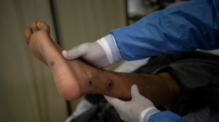 Monkeypox mostly spreads before symptoms appear, study suggests